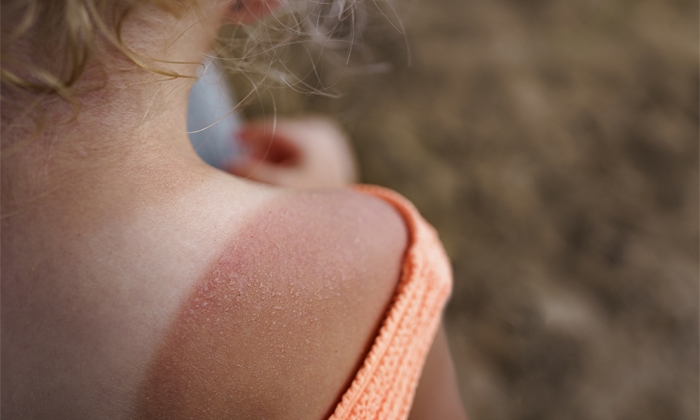 El Sol, aliado y enemigo este verano